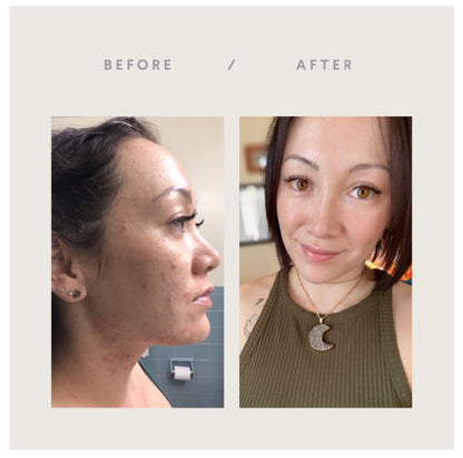 Before and After using Flawless Gel Cleanser from Lather and Soul